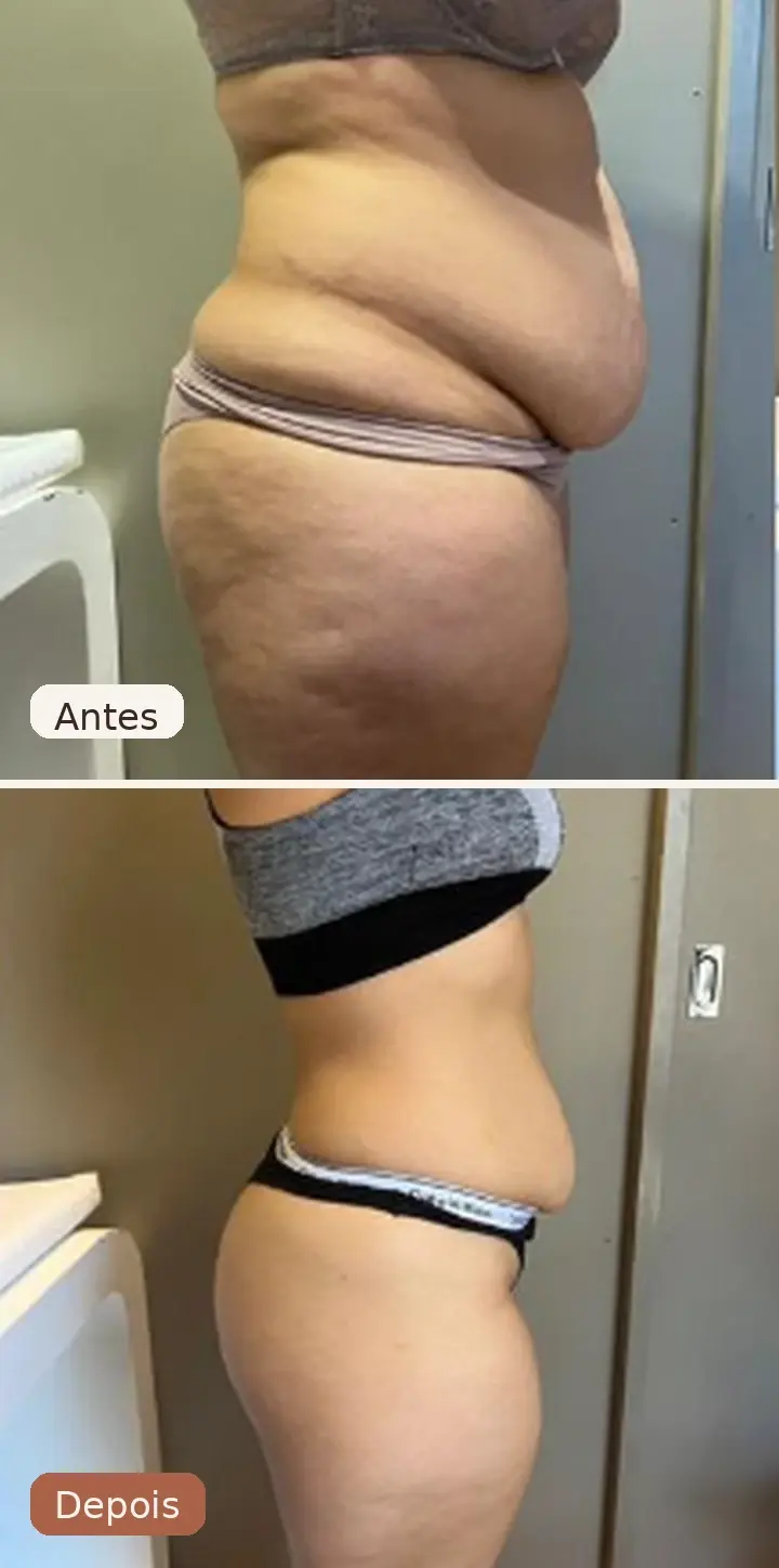 Resultado de tratamento realizado na Clínica Juliana Ribeiro 2